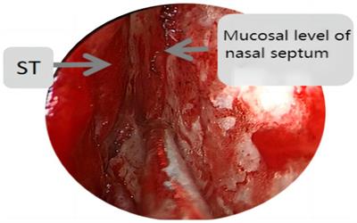 Clinical study on the selection of endoscopes and microscopes for transsphenoidal surgery of non-aggressive pituitary macroadenoma and microadenoma and the influencing factors of hyposmia after endoscopic transsphenoidal surgery